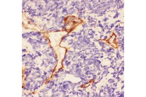 Anti-Laminin Picoband antibody,  IHC(P): Human Lung Cancer Tissue