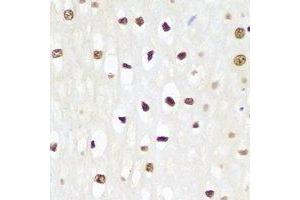Immunohistochemical analysis of p62 staining in human esophageal cancer formalin fixed paraffin embedded tissue section. (KHDRBS1 anticorps)