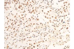ABIN6267286 at 1/100 staining human lung cancer tissue sections by IHC-P.