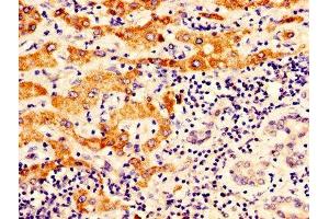 IHC image of ABIN7162288 diluted at 1:400 and staining in paraffin-embedded human liver cancer performed on a Leica BondTM system. (OTC anticorps  (AA 33-354))