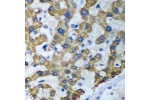 Immunohistochemical analysis of ACT1 staining in human liver cancer formalin fixed paraffin embedded tissue section.