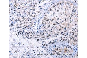 Immunohistochemistry of Human lung cancer using HMGB3 Polyclonal Antibody at dilution of 1:20 (HMGB3 anticorps)