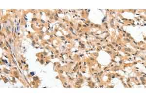 Immunohistochemistry of paraffin-embedded Human thyroid cancer tissue using APTX Polyclonal Antibody at dilution 1:50 (Aprataxin anticorps)