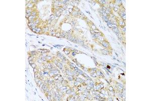Immunohistochemistry of paraffin-embedded human colon carcinoma using LYZ antibody (ABIN5975352) at dilution of 1/100 (40x lens). (LYZ anticorps)