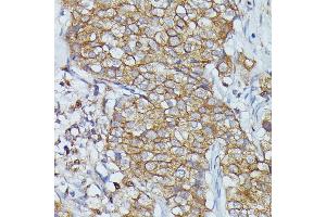 Immunohistochemistry of paraffin-embedded human mammary cancer using Cortactin antibody  at dilution of 1:100 (40x lens).