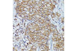 Immunohistochemistry of paraffin-embedded human mammary cancer using Cortactin antibody  at dilution of 1:100 (40x lens). (Cortactin anticorps  (AA 1-200))