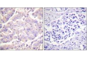 Immunohistochemistry analysis of paraffin-embedded human colon carcinoma tissue, using c-PLA2 (Ab-505) Antibody. (C-PLA2 (AA 471-520) anticorps)