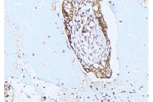 ABIN6275353 at 1/100 staining Human lung cancer tissue by IHC-P. (PEX10 anticorps  (Internal Region))