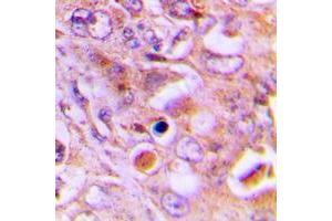 Immunohistochemical analysis of RPL18 staining in human lung cancer formalin fixed paraffin embedded tissue section.