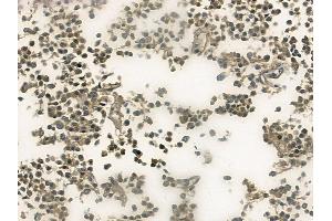 ABIN6256493 and ABIN6267533 at 1/100 staining human glioblastoma by IHC-P. (CDKN1B anticorps  (pThr187))