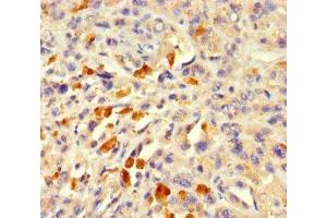 Immunohistochemistry of paraffin-embedded human melanoma using ABIN7143055 at dilution of 1:100