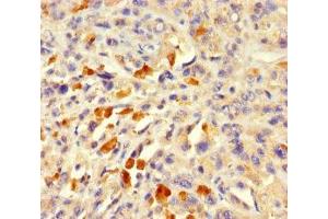 Immunohistochemistry of paraffin-embedded human melanoma using ABIN7143055 at dilution of 1:100 (Actin-Like 7A anticorps  (AA 1-435))