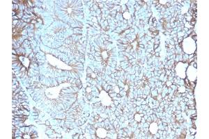 Formalin-fixed, paraffin-embedded human Colon stained with Cadherin 17 / CDH17 Mouse Monoclonal Antibody (CDH17/2617). (LI Cadherin anticorps  (AA 242-418))