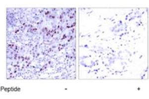 Immunohistochemical analysis of paraffin-embedded human breast carcinoma tissue using GATA1 polyclonal antibody . (GATA1 anticorps  (Ser142))