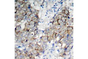 Immunohistochemistry of paraffin-embedded human breast carcinoma using Phospho-IGF1R-Y1161 antibody (ABIN2988064). (IGF1R anticorps  (pTyr1161))
