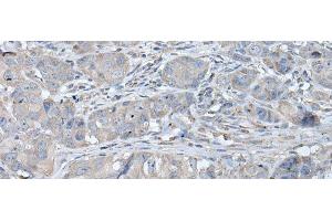 Immunohistochemistry of paraffin-embedded Human breast cancer tissue using RASA1 Polyclonal Antibody at dilution of 1:40(x200) (RASA1 anticorps)