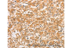 Immunohistochemistry of Human gastric cancer using TLR3 Polyclonal Antibody at dilution of 1:50