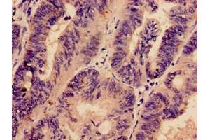Immunohistochemistry analysis of human colon cancer using ABIN7163177 at dilution of 1:100 (PREX1 anticorps  (AA 1-44))