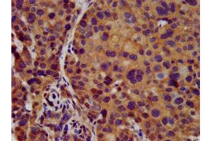 IHC image of ABIN7145029 diluted at 1:500 and staining in paraffin-embedded human pancreatic cancer performed on a Leica BondTM system. (KCNJ8 anticorps  (AA 299-424))