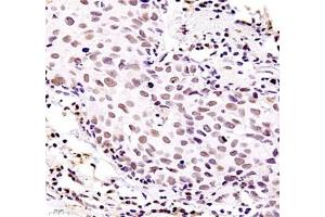 Immunohistochemistry of paraffin embedded human breast cancer using ZKSCAN4 (ABIN7076265) at dilution of 1:400 (400x lens) (ZKSCAN4 anticorps)