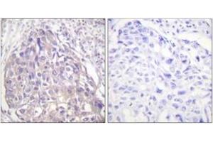Immunohistochemistry analysis of paraffin-embedded human breast carcinoma, using FOXO1/3/4-pan (Phospho-Thr24/32) Antibody. (FOXO1 anticorps  (pThr24))