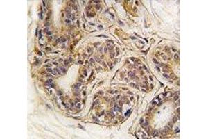 IHC analysis of FFPE human breast carcinoma tissue stained with CASC3 antibody