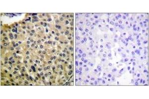 Immunohistochemistry analysis of paraffin-embedded human breast carcinoma, using KIT (Phospho-Tyr703) Antibody.