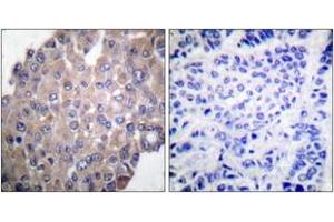 Immunohistochemistry analysis of paraffin-embedded human breast carcinoma, using PLCG1 (Phospho-Tyr771) Antibody. (Phospholipase C gamma 1 anticorps  (pTyr771))