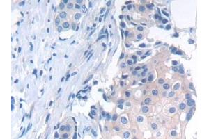 Detection of NCAD in Human Breast cancer Tissue using Polyclonal Antibody to N-cadherin (NCAD)