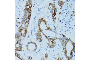 Immunohistochemistry of paraffin-embedded human colon carcinoma using CTSE antibody (ABIN5971444) at dilution of 1/100 (40x lens). (Cathepsin E anticorps)