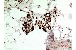 Immunohistochemistry (IHC) analysis of paraffin-embedded Human Breast Cancer, antibody was diluted at 1:100.