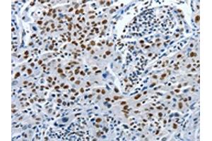 The image on the left is immunohistochemistry of paraffin-embedded Human lung cancer tissue using ABIN7191895(PIWIL3 Antibody) at dilution 1/20, on the right is treated with synthetic peptide. (PIWIL3 anticorps)