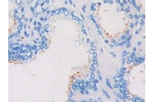 Detection of CRKL in Human Prostate Tissue using Polyclonal Antibody to Crk Like Protein (CRKL)