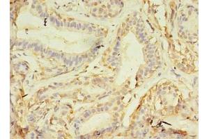 Immunohistochemistry of paraffin-embedded human breast cancer using ABIN7161747 at dilution of 1:100