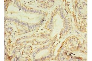 Immunohistochemistry of paraffin-embedded human breast cancer using ABIN7161747 at dilution of 1:100 (NAIF1 anticorps  (AA 1-172))