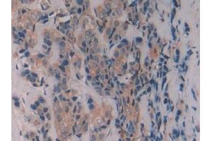 Detection of CAV1 in Human Breast cancer Tissue using Polyclonal Antibody to Caveolin 1 (CAV1) (Caveolin-1 anticorps  (AA 2-104))