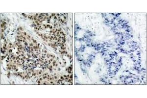 Immunohistochemistry analysis of paraffin-embedded human breast carcinoma, using FKHR (Phospho-Ser256) Antibody. (FOXO1 anticorps  (pSer256))