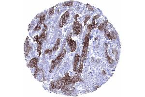 Squamous cell carcinoma with variable Dsg1 staining of tumor cells showing only weak staining at the periphery of tumor cell nests