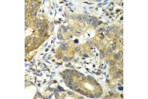 Immunohistochemistry of paraffin-embedded human gastric cancer using DPP3 antibody. (DPP3 anticorps)