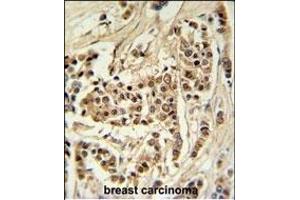 TTL Antibody (C-term) (ABIN651357 and ABIN2840199) IHC analysis in formalin fixed and raffin embedded human breast carcinoma followed by peroxidase conjugation of the secondary antibody and DAB staining. (TTPAL anticorps  (C-Term))