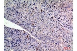 Immunohistochemistry (IHC) analysis of paraffin-embedded Human Liver Cancer, antibody was diluted at 1:100. (FGF2 anticorps  (Internal Region))