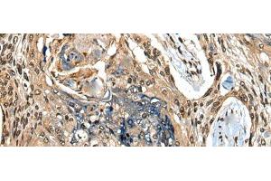 Immunohistochemistry of paraffin-embedded Human esophagus cancer tissue using CAMKK1 Polyclonal Antibody at dilution of 1:35(x200) (CAMKK1 anticorps)