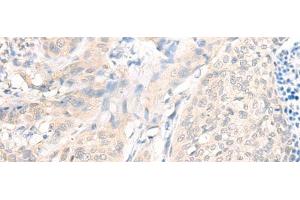 Immunohistochemistry of paraffin-embedded Human cervical cancer tissue using AOAH Polyclonal Antibody at dilution of 1:25(x200) (AOAH anticorps)