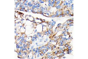 Immunohistochemistry of paraffin-embedded human oophoroma using AIF antibody (ABIN7265648) at dilution of 1:100 (40x lens). (AIF anticorps)