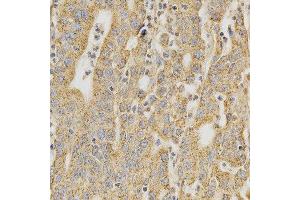 Immunohistochemistry of paraffin-embedded human stomach cancer using DNMT3A antibody at dilution of 1:200 (x400 lens) (DNMT3A anticorps  (AA 500-700))