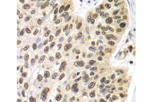 Immunohistochemistry of paraffin-embedded Human lung cancer using SEPT7 Polyclonal Antibody at dilution of 1:100 (40x lens).