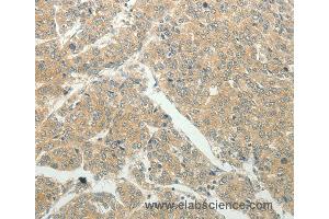 Immunohistochemistry of Human liver cancer using SLC8A3 Polyclonal Antibody at dilution of 1:50 (SLC8A3 anticorps)