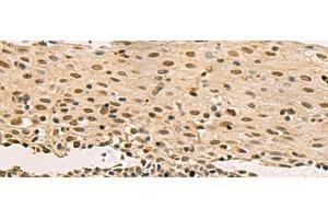 Immunohistochemistry of paraffin-embedded Human cervical cancer tissue using LRIF1 Polyclonal Antibody at dilution of 1:70(x200)