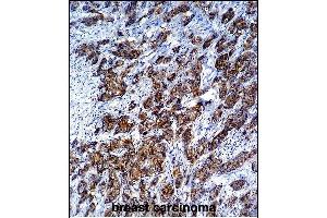 LGALS3 Antibody (C-term) (ABIN1536595 and ABIN2843799) immunohistochemistry analysis in formalin fixed and paraffin embedded human breast carcinoma followed by peroxidase conjμgation of the secondary antibody and DAB staining.