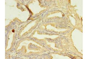 Immunohistochemistry of paraffin-embedded human prostate cancer using ABIN7169587 at dilution of 1:100 (SFXN2 anticorps  (AA 1-99))